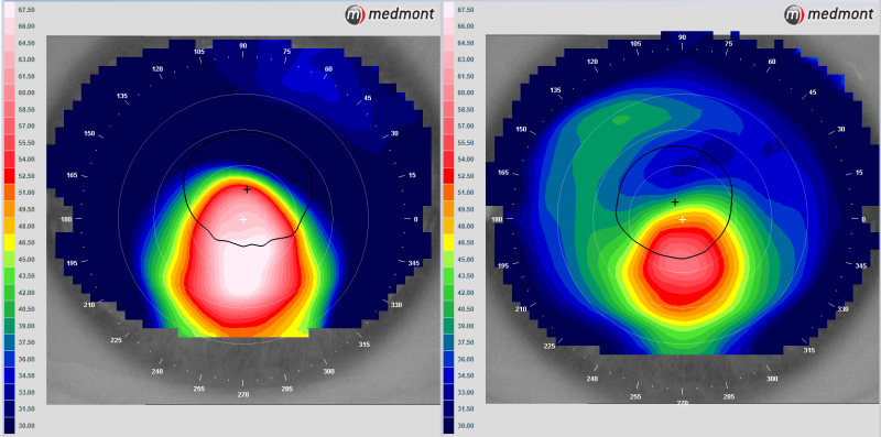 chẩn đoán giác mạc hình chóp