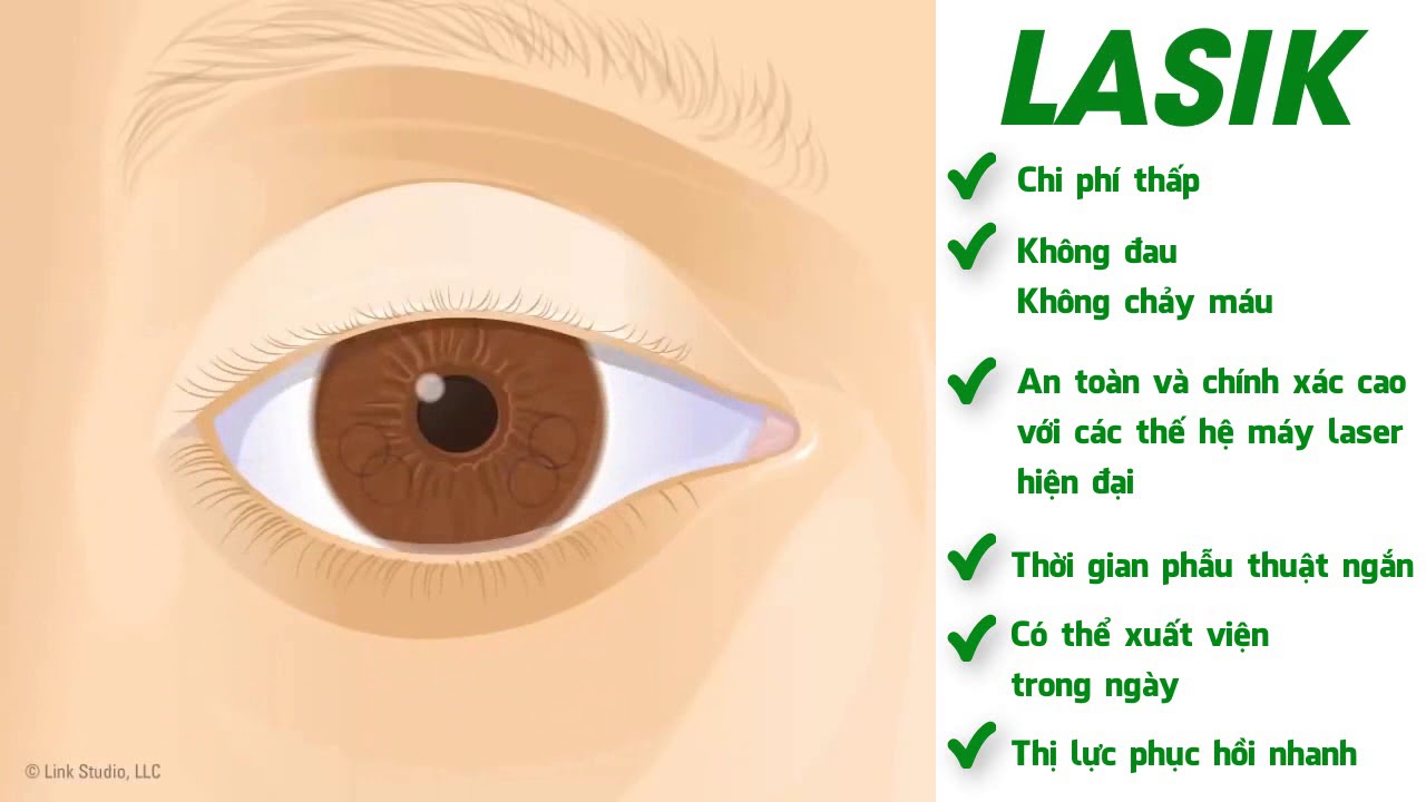 So sánh các phương pháp phẫu thuật chữa tật khúc xạ bằng laser excimer