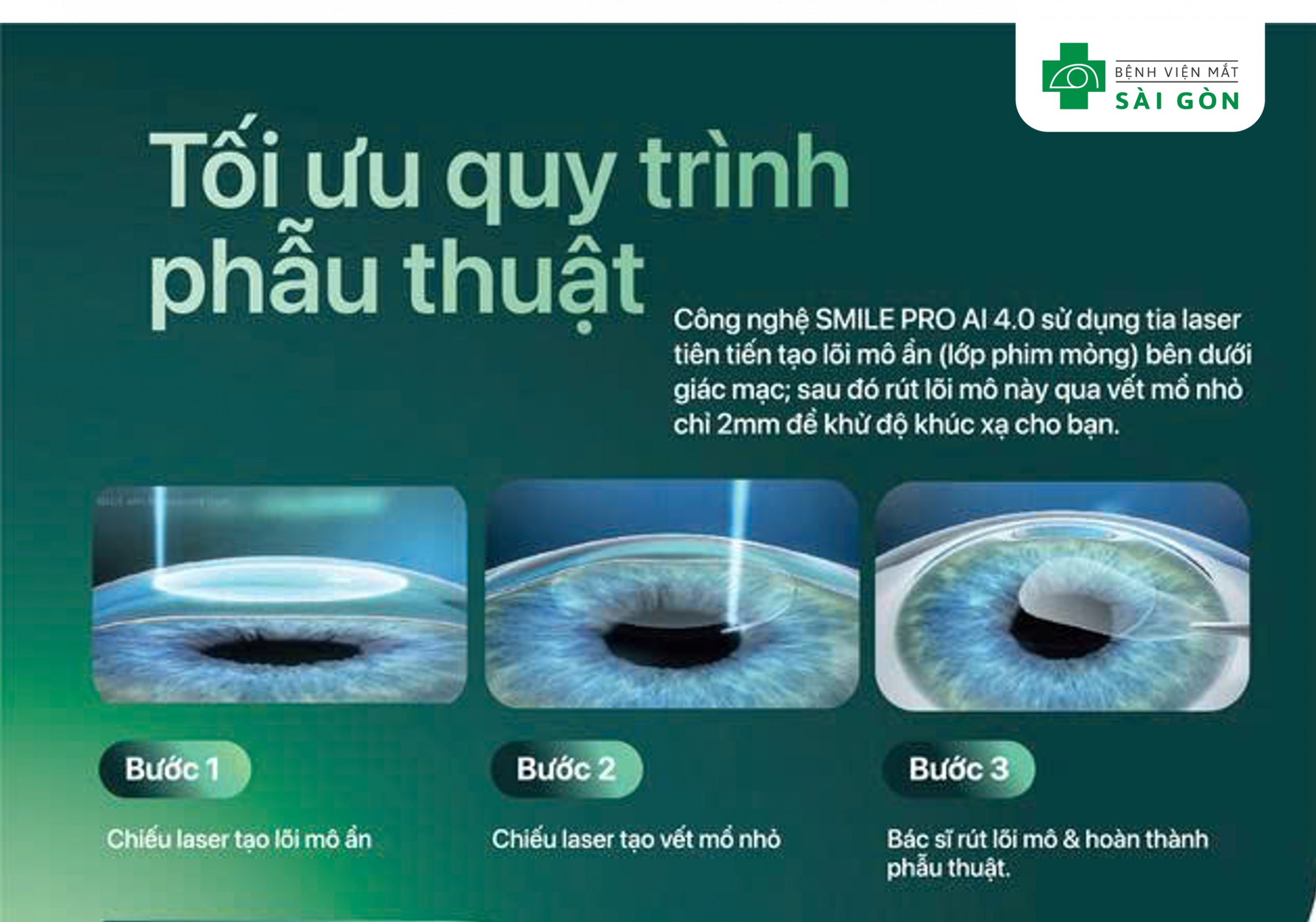 Chi tiết các bước trong quy trình phẫu thuật SMILE PRO AI 4.0