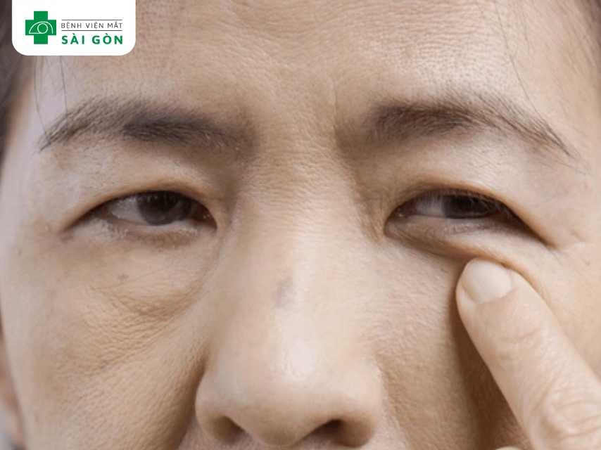 Sụp mí mắt làm cản trở tầm nhìn và thẩm mỹ