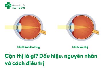 Tìm hiểu chung về bệnh mắt cận thị
