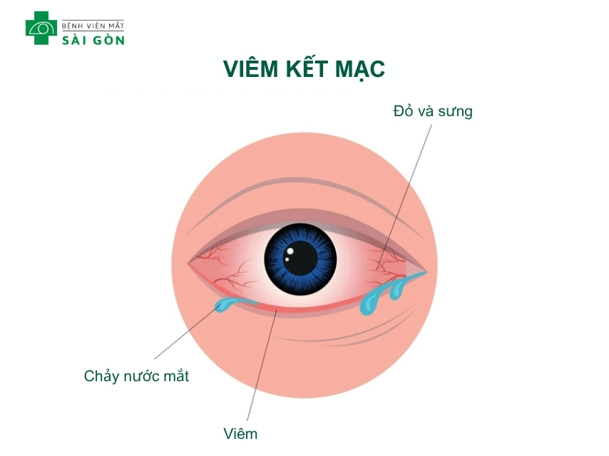 Tình trạng bệnh đau mắt đỏ (viêm kết mạc)