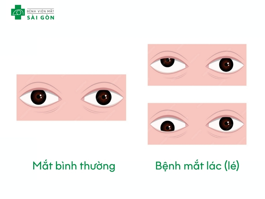 Lác mắt khiến hai mắt không thể nhìn về một hướng