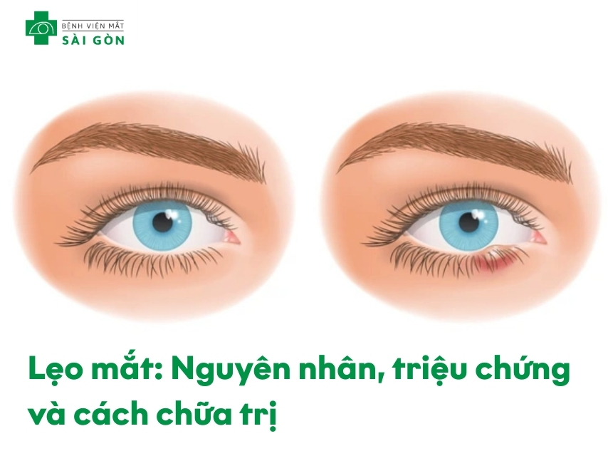 Mắt bị lẹo với khối sưng đỏ ở mí mắt
