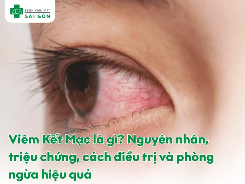 Bệnh viêm kết mạc (đau mắt đỏ)