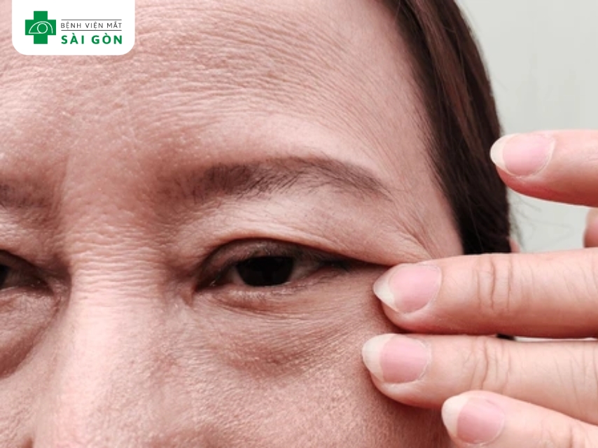 Có 2 dạng sụp mí mắt chính