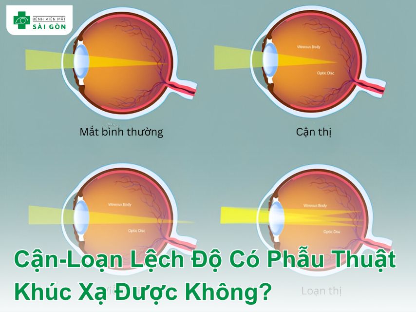 Mắt bình thường và mắt cận-loạn lệch độ