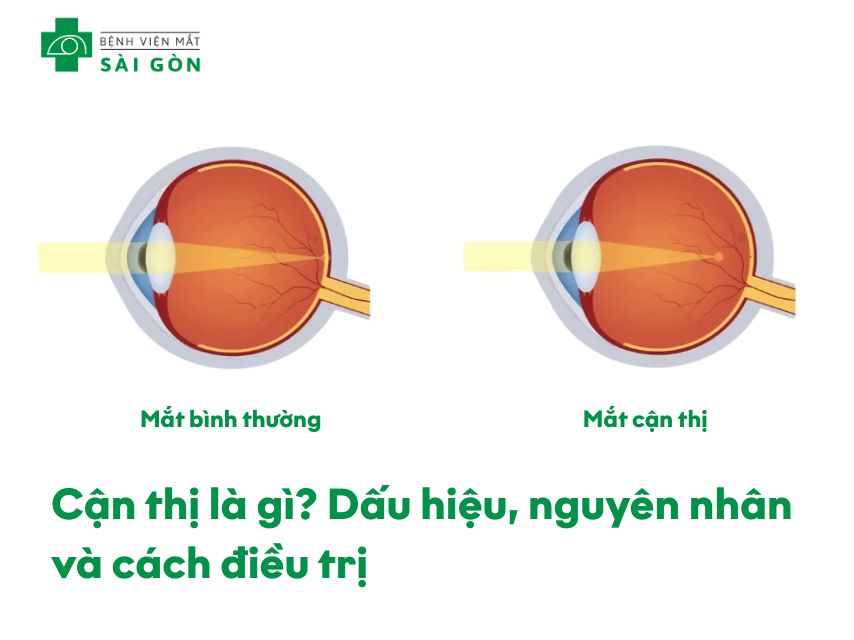Tìm hiểu chung về bệnh mắt cận thị