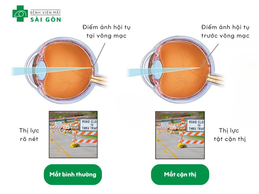 Cận thị là tật khúc xạ làm mờ tầm nhìn xa