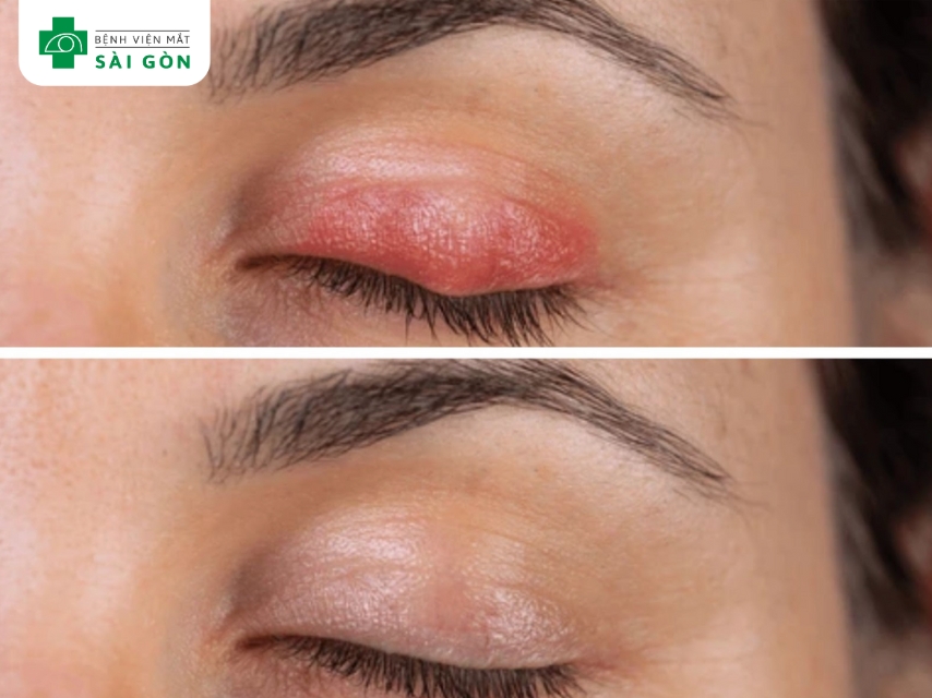 Chắp mắt không lây nhiễm