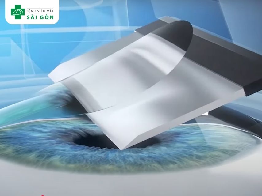 LASIK sử dụng dao vi phẫu kết hợp laser Excimer