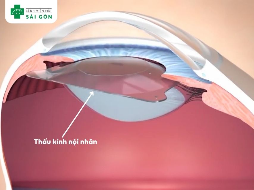 PHAKIC sử dụng thấu kính nội nhãn tương thích sinh học