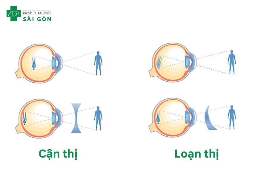 Đường đi của ánh sáng qua mắt cận thị và mắt loạn thị có đeo kính điều chỉnh