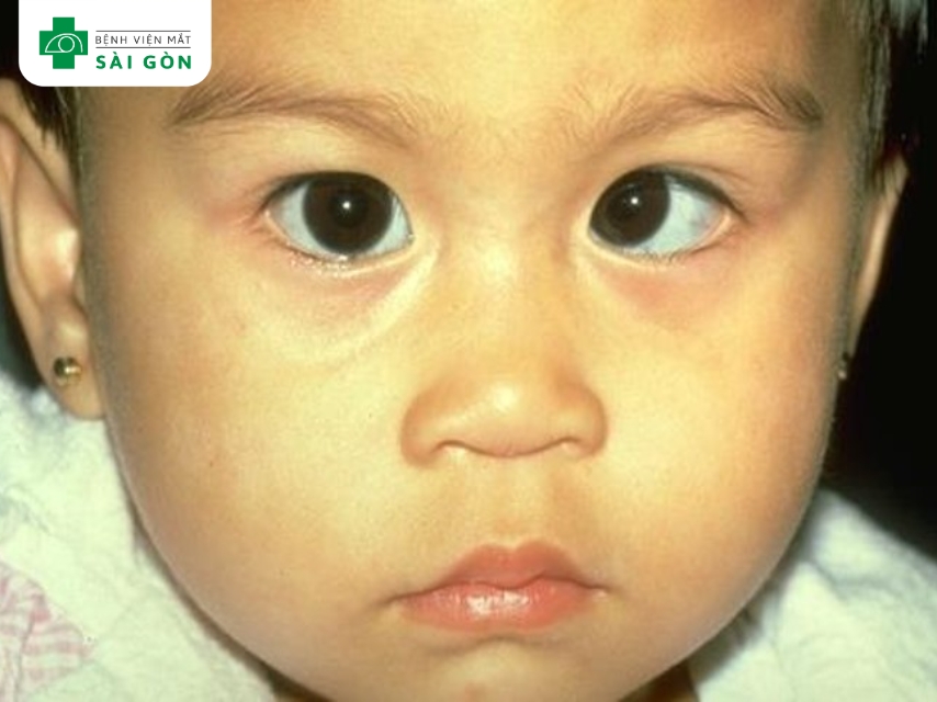 Người bị nhược thị thường nheo mắt khi nhìn gần hoặc xa