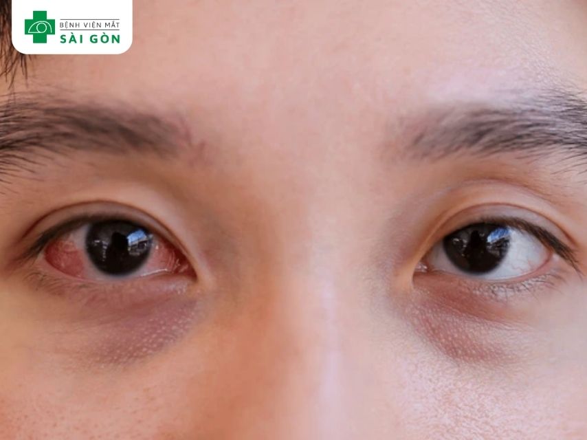 Đau nhức mắt là dấu hiệu viêm giác mạc