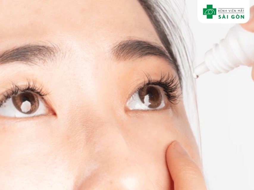 Cách điều trị viêm kết mạc hiệu quả