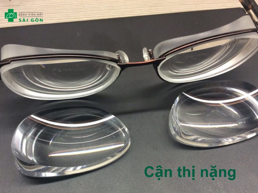 Độ cận từ 6,25-10 Diop là mức độc cận thị nặng