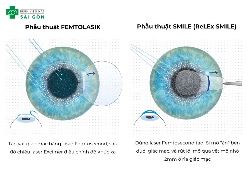 Điểm khác nhau của hai phương pháp FEMTOLASIK và ReLEx SMILE