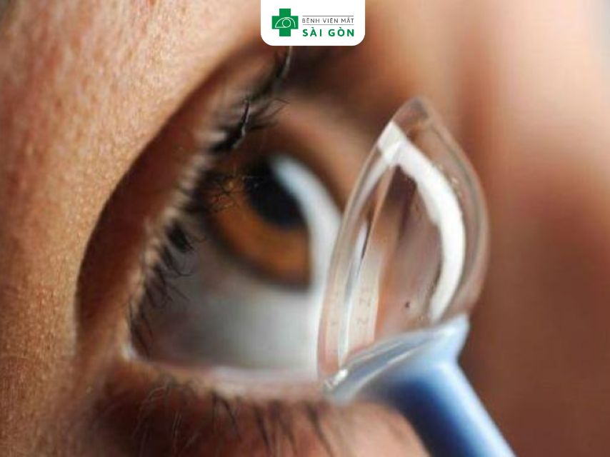 Kính áp tròng Ortho - K định hình mặt giác mạc