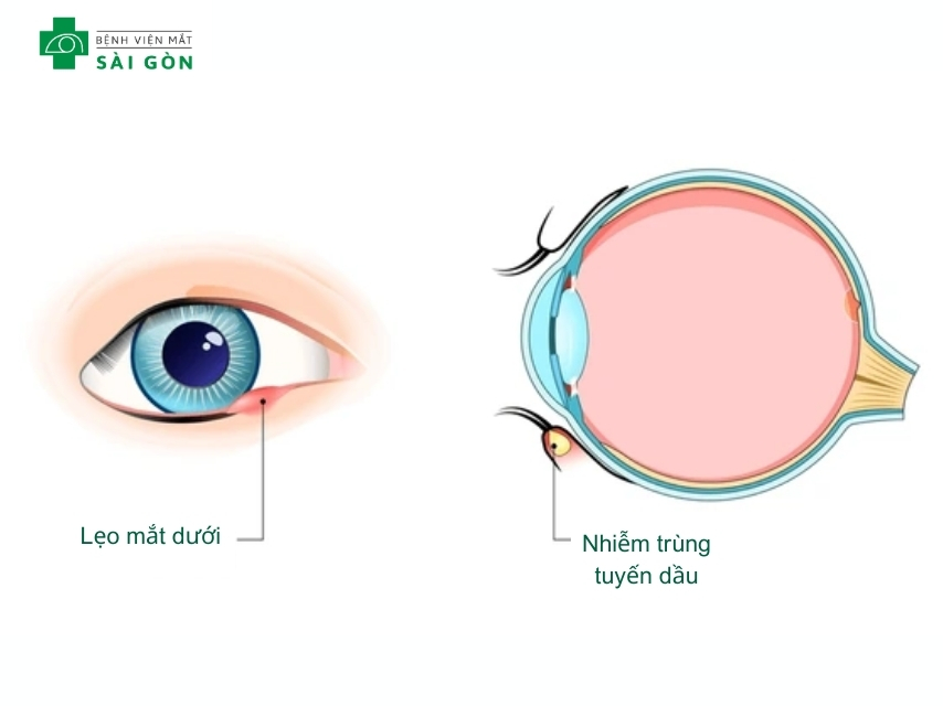 Lẹo mắt là một cục sưng nhỏ có màu đỏ trên mi mắt