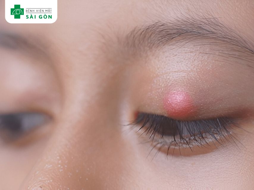 Lẹo mắt khiến mí mắt bị sưng