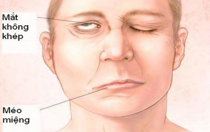 liệt dây thần kinh số 6