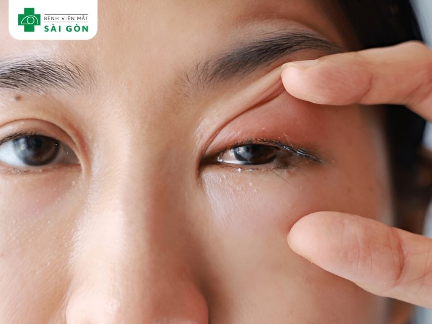 Không dụi tay vào vùng bị sưng