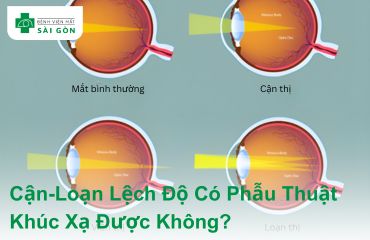 Mắt bình thường và mắt cận-loạn lệch độ