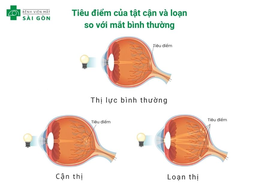 Mắt cận loạn là tình trạng bị cận thị, loạn thị