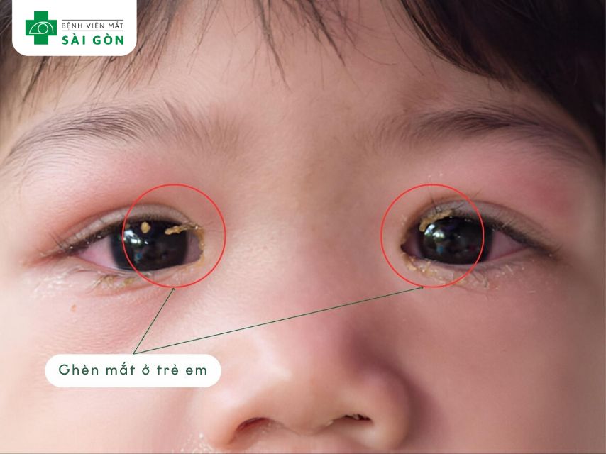 Mắt đổ ghèn là dịch tiết của mủ hoặc nước mắt