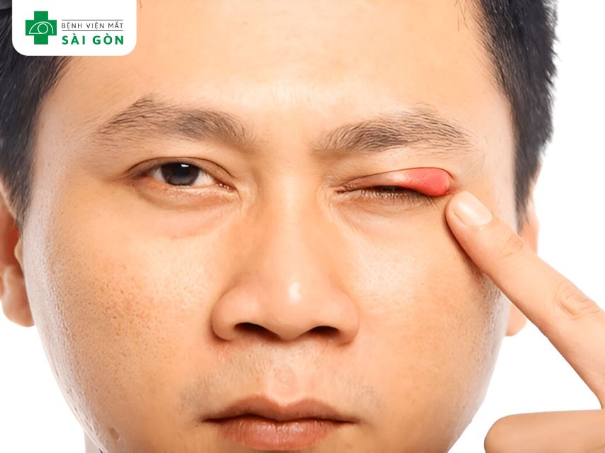 Mí mắt thường gây cộm, ngứa