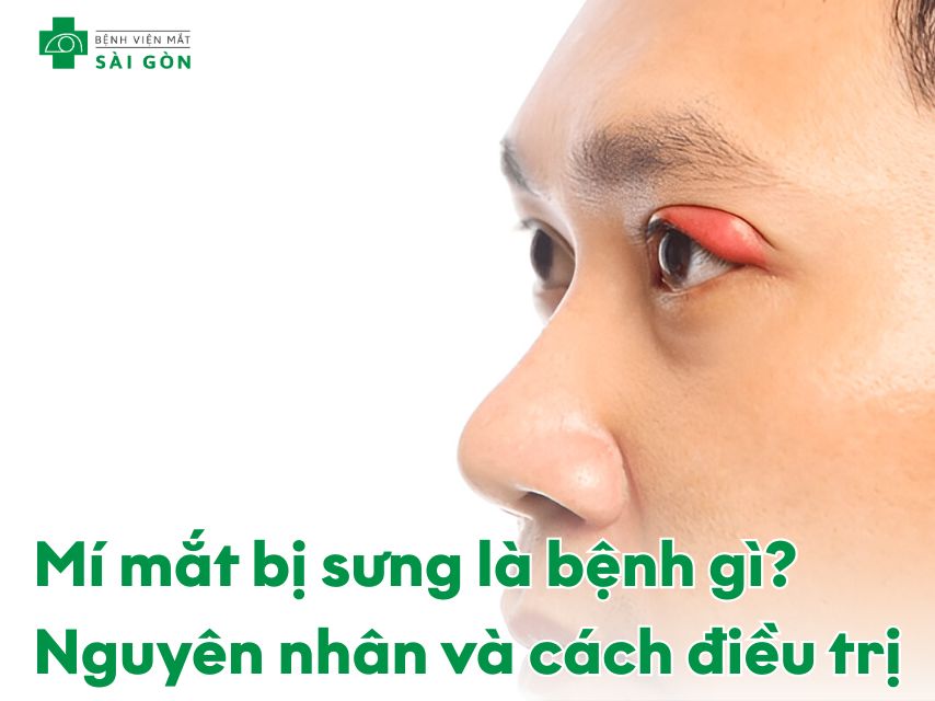 Tổng quan chung tình trạng mí mắt bị sưng