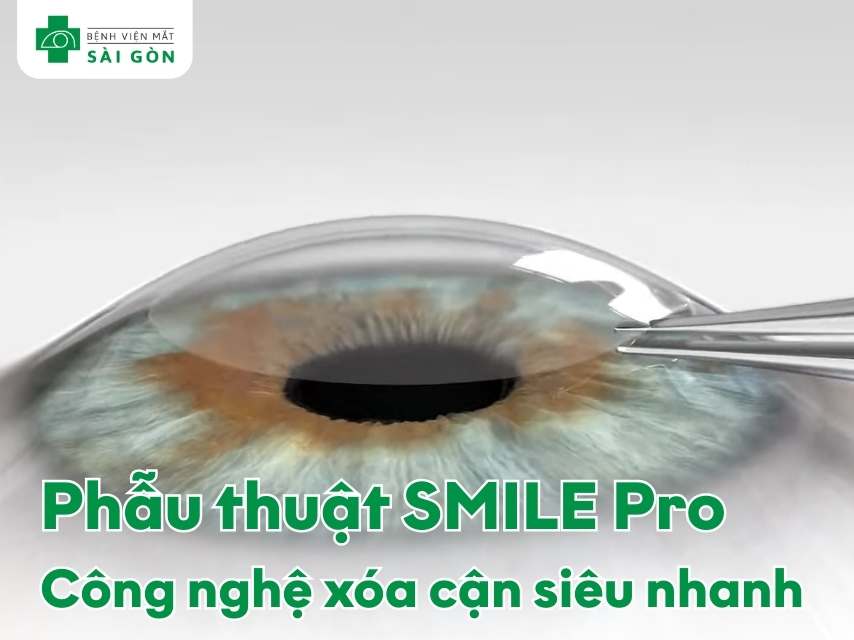 SMILE Pro công nghệ mổ cận tiên tiến