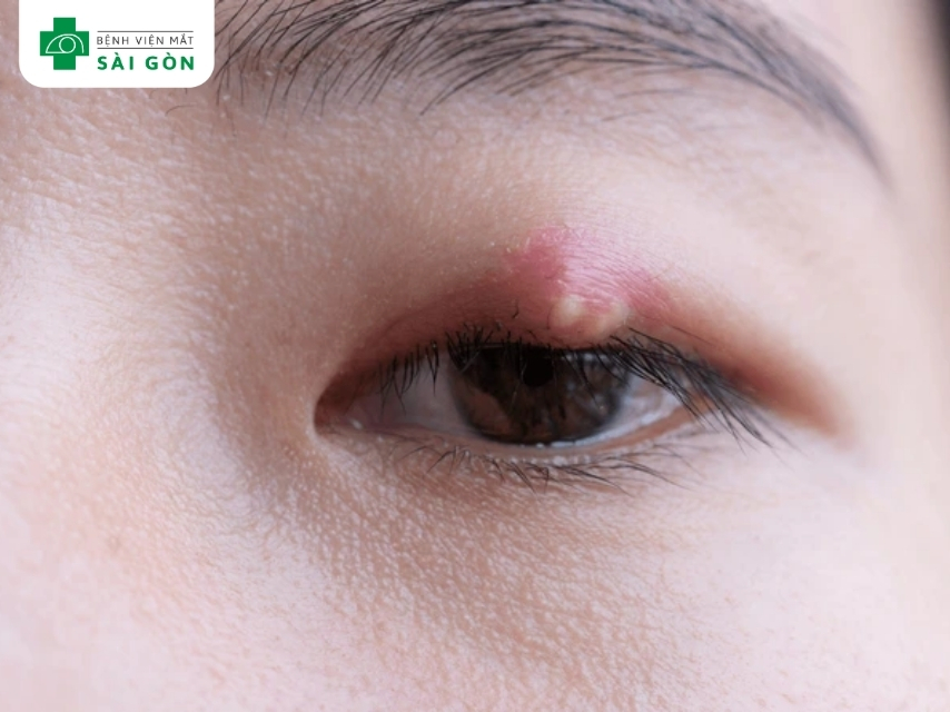 Vi khuẩn Staphylococcus aureus là nguyên nhân chính gây lẹo mắt