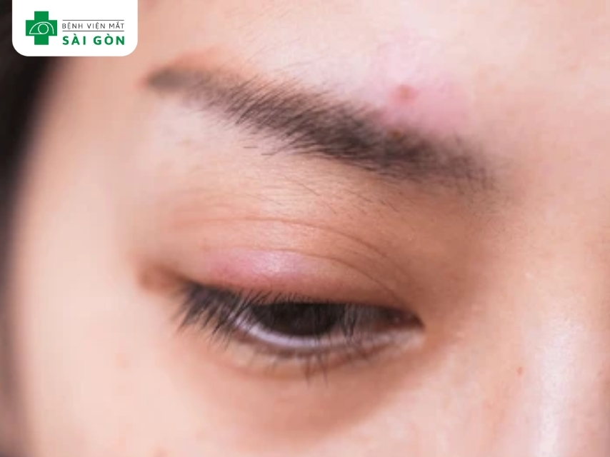 Tắc nghẽn của các ống dẫn tuyến Meibomius gây ra chắp mắt