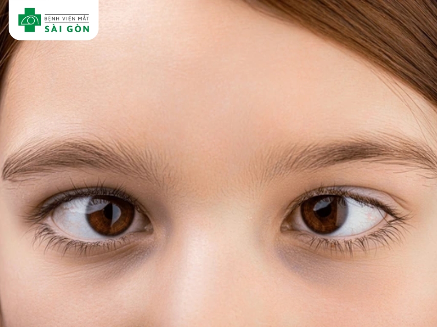 Lé mắt là nguyên nhân phổ biến gây nhược thị