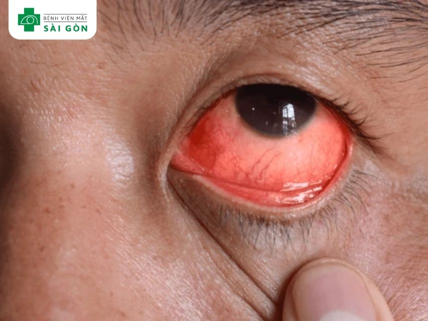 Nguyên nhân chủ yếu của viêm giác mạc