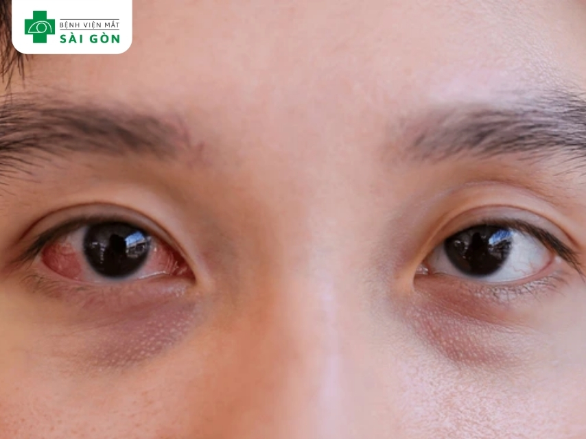 Nhận biết bệnh viêm kết mạc