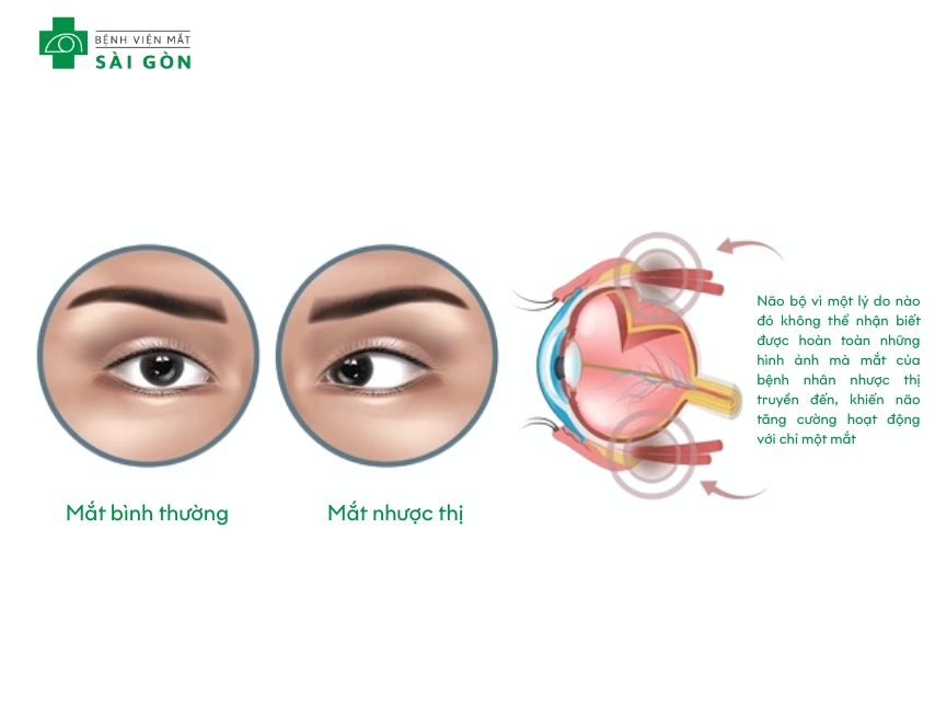 Nhược thị là tình trạng một hoặc hai bên mắt thị suy giảm chức năng