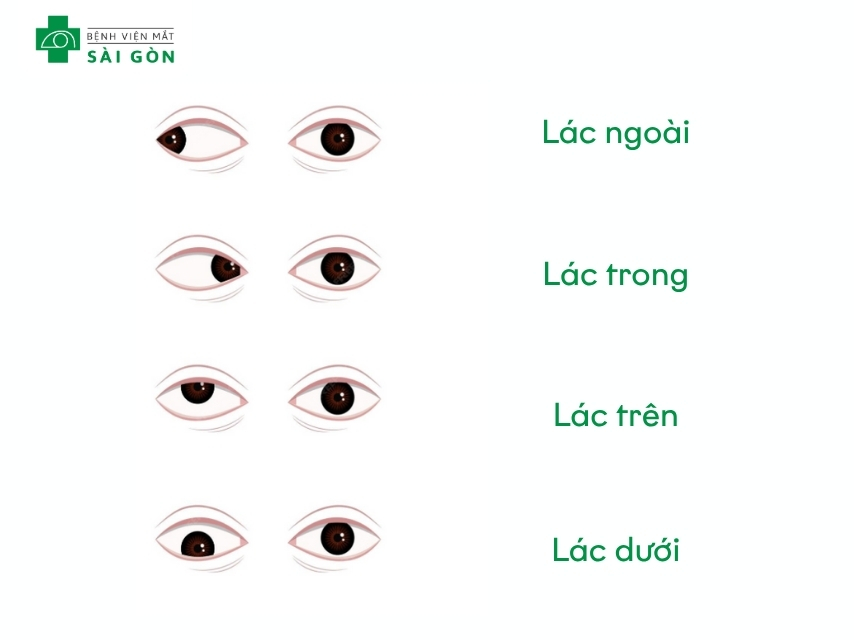 Hướng lệch mắt sẽ tương ứng loại bệnh lác