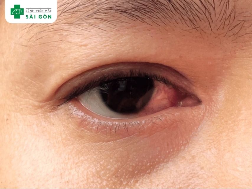 Phân loại viêm giác mạc theo mức độ và vị trí tổn thương