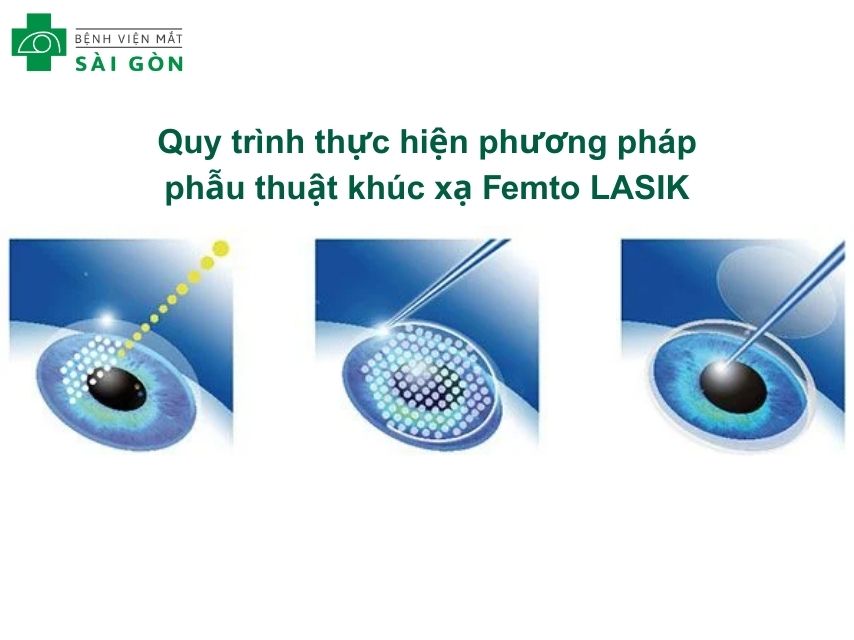 Phương pháp mổ mắt Femtosecond lasik
