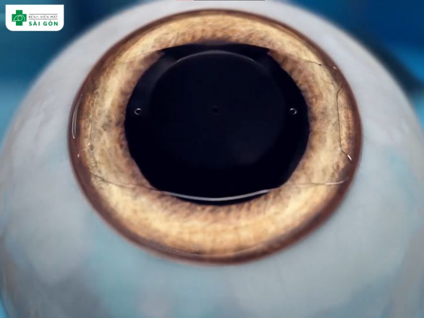 PHAKIC có thể trị cận và viễn thị