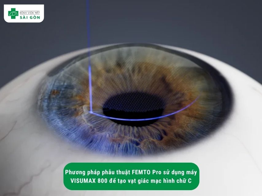 Thông tin về phẫu thuật FEMTO Pro