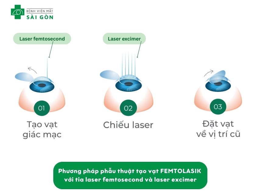 FEMTOLASIK sử dụng laser femtosecond tạo vạt
