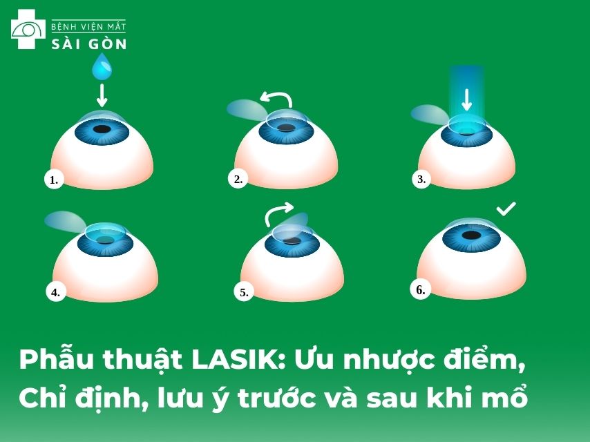 Khái niệm phẫu thuật LASIK, độ an toàn và ưu nhược điểm