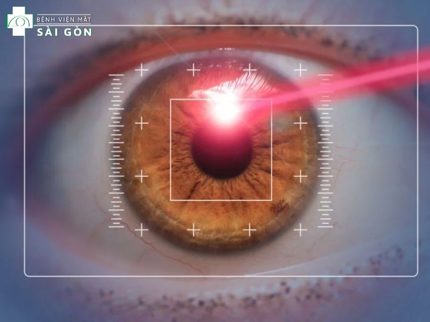 Phương pháp phẫu thuật mổ mắt Femto Pro