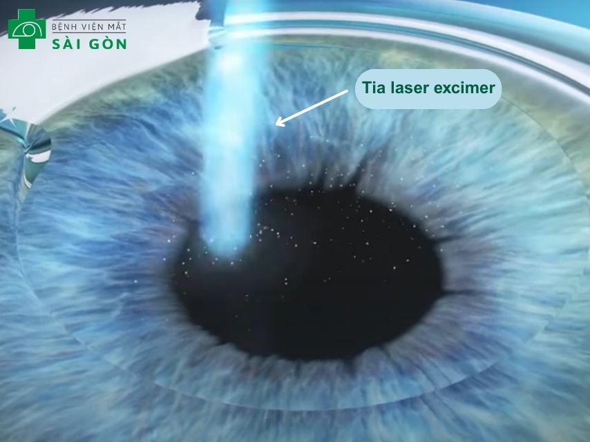Phương pháp mổ mắt cận bằng tia laser