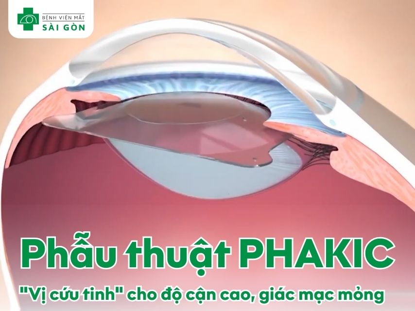 Phẫu thuật PHAKIC cho người cận cao