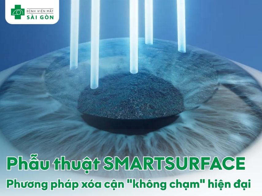 Phẫu thuật xóa cận SMARTSURFACE